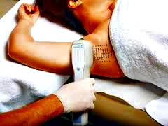 MiraDry tratamiento hiperhidrosis Mira Dry tratamiento hiperhidrosis