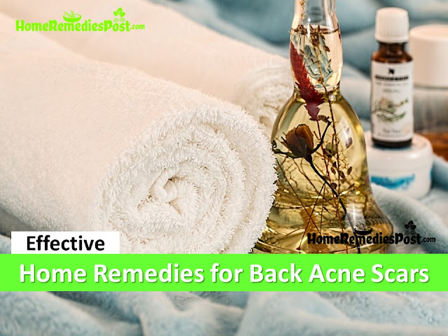 21 Home Remedies to Get Rid of Back Acne Scars Fast how to get rid of back acne scars, home remedies for back acne scars, clear back acne scars, remove acne scars fast, back acne scars treatment, back acne scars home remedies, how to cure back acne scars, how to cure back acne scars fast, back acne scars remedies, how to treat back acne scars fast,
