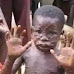 SO SAD! MONKEYPOX VICTIM COMMITTED SUICIDE IN BAYELSA STATE, NIGERIA. 