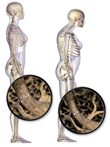 Osteoporosis-Causes, Symptoms, Prevention and Treatment