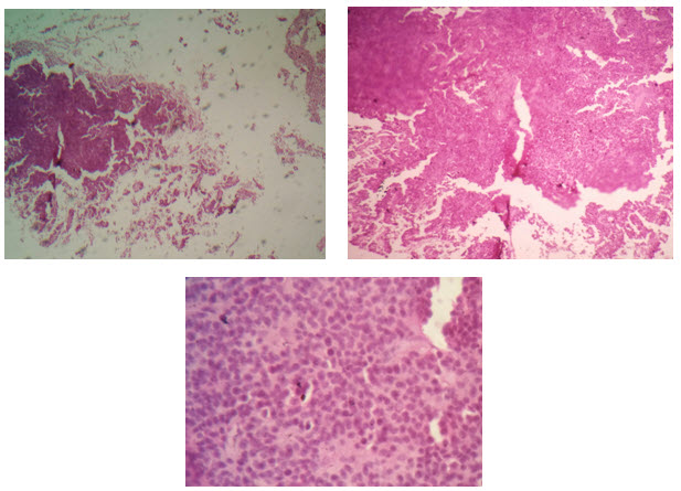 Histopathologic examination of the squash specimen giving impression of pituitary macroadenoma