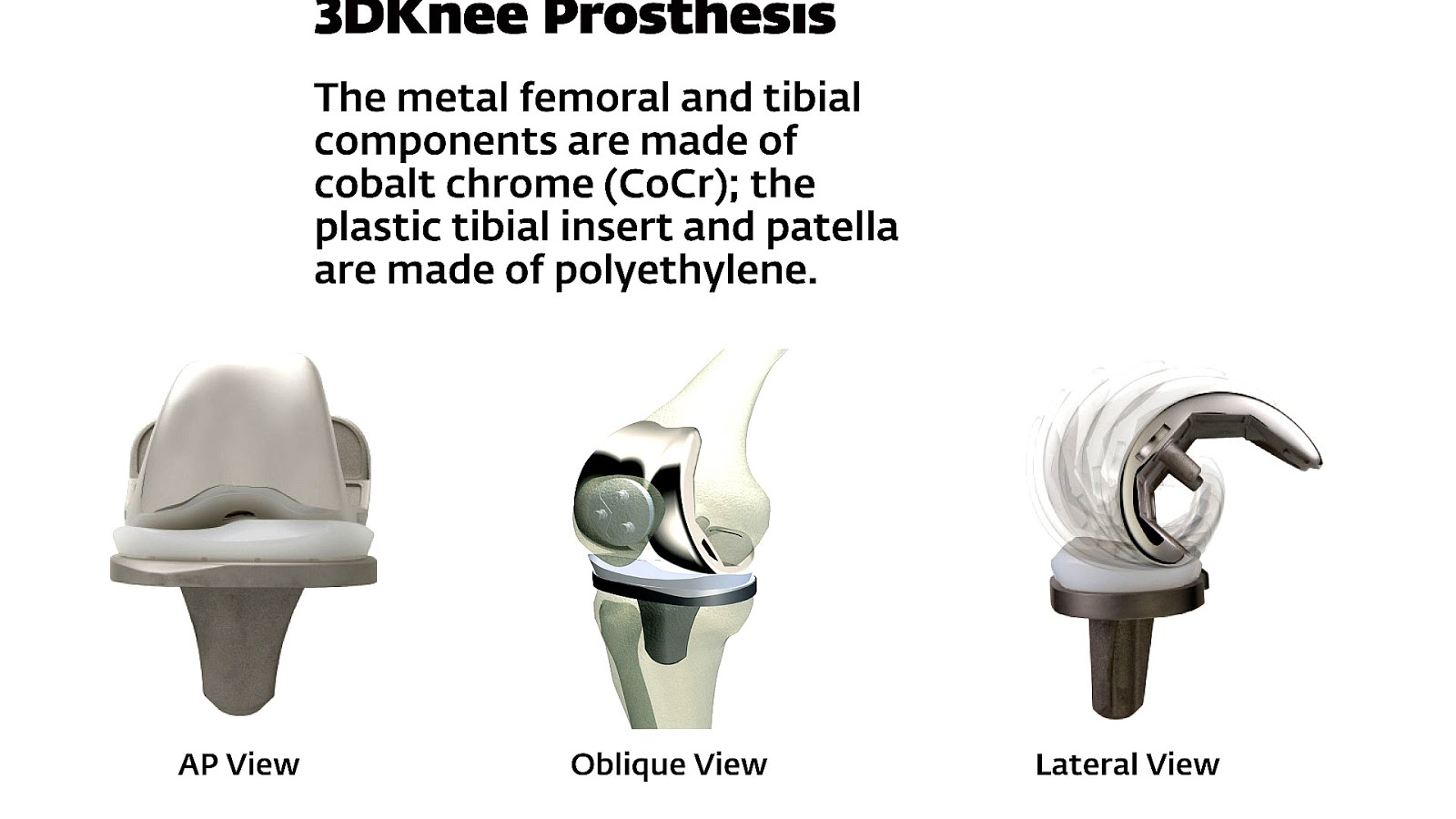 Total Knee Replacement Types