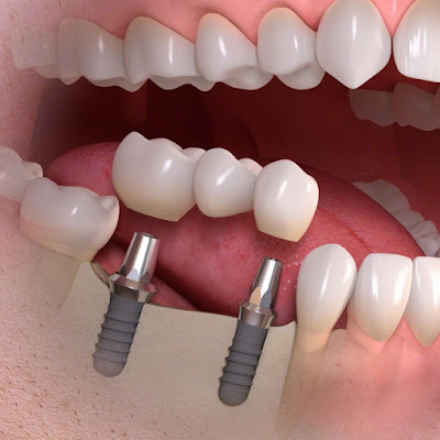 Trường hợp nào nên làm cầu răng sứ? 