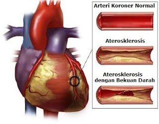 Penyakit Jantung Aterosklerosis