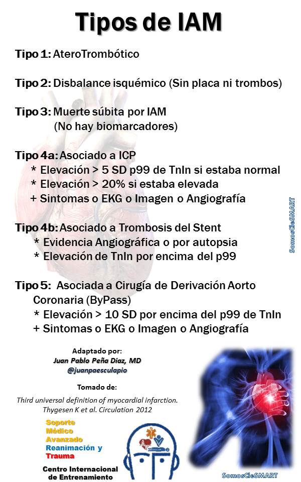 infarto de miocardio tipo 2