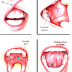 Oral Cancer - Cure For Oral Cancer