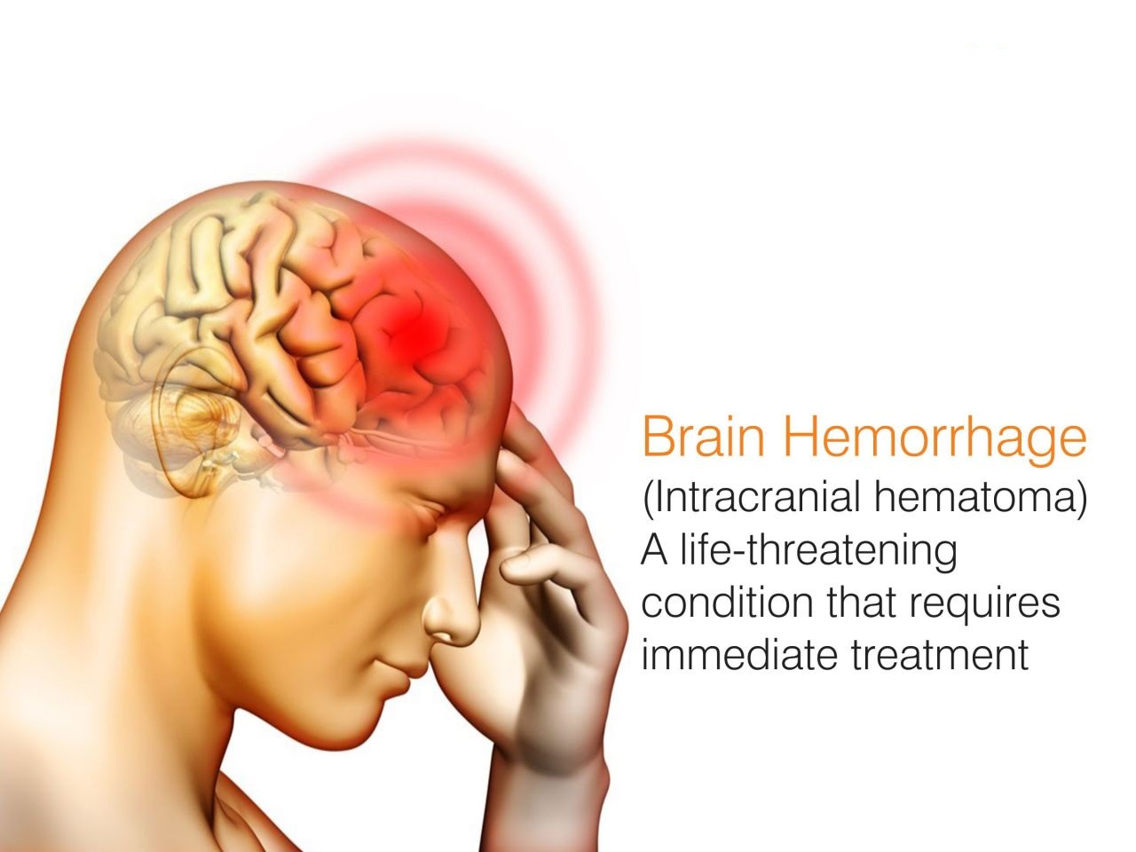 HealthOpinion Early Signs That Help You Spot Brain Hemorrhage