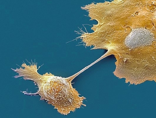 Stage IV Pancreatic Cancer