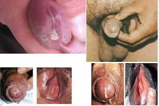 OBAT PENIS MENGELUARKAN CAIRAN KENTAL BERBAU DAN TERASA NYERI OBAT PENIS MENGELUARKAN CAIRAN KENTAL BERBAU DAN TERASA NYERI