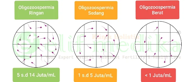 Oligozoospermia (Oligospermia) Ringan, Sedang dan Berat Oligozoospermia (Oligospermia) Ringan, Sedang dan Berat