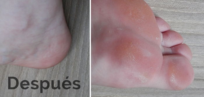 Peeling pies antes después