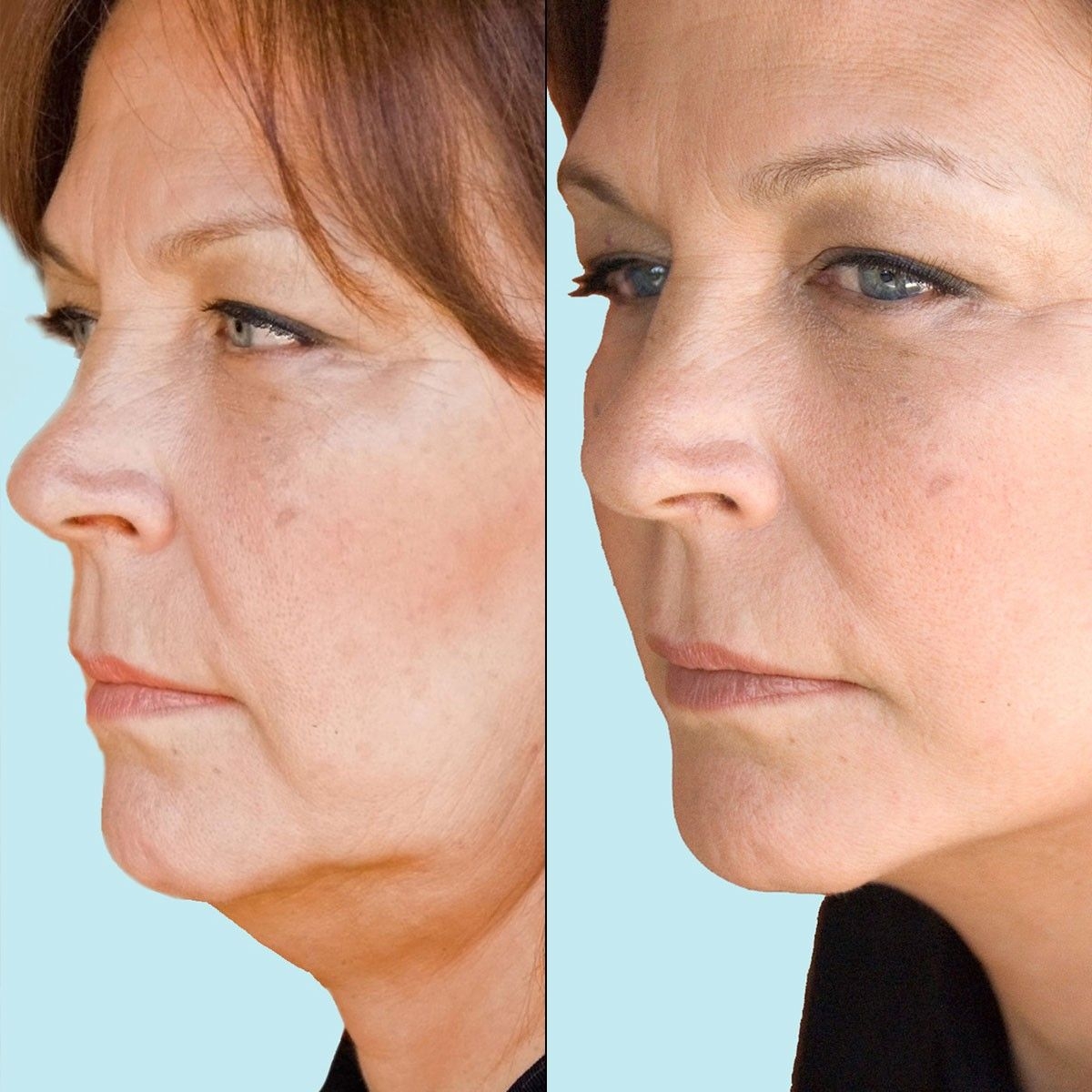 The Combination Of Yoga Facial Exercises And NonInvasive Facelifts