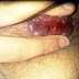 PENGOBATAN WASIR AKUT thumbnail