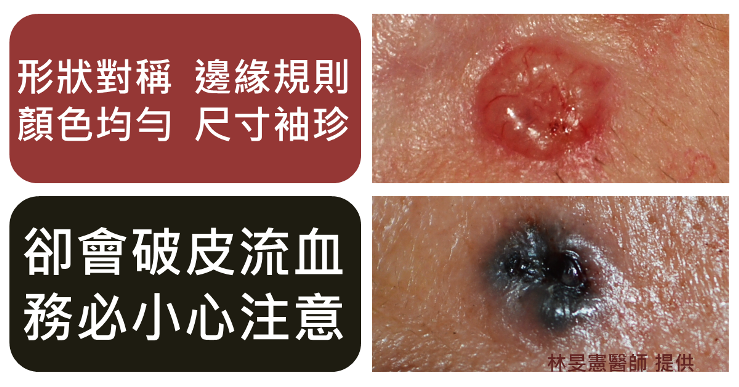 基底細胞癌長得像顆痣但會破皮流血