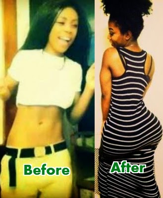 nigerian lady buttock injection surgery