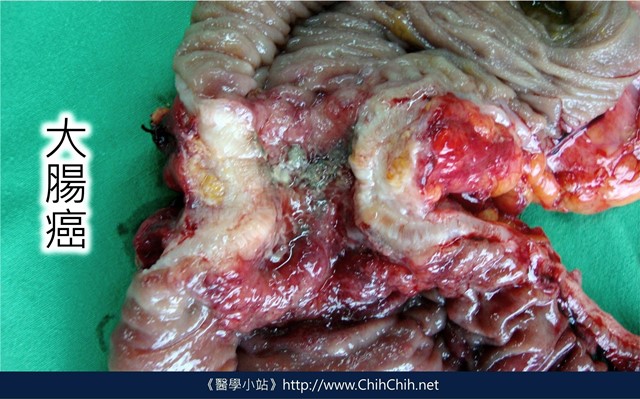 大腸癌的照片