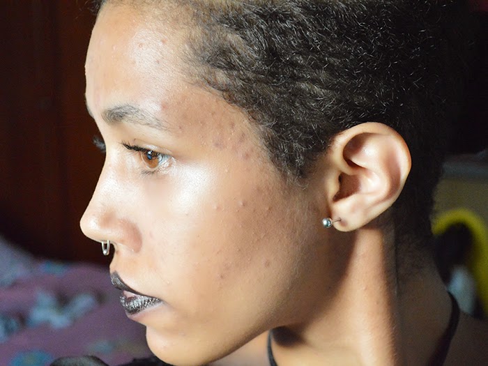 Vitanol A para a Acne: Primeira semana
