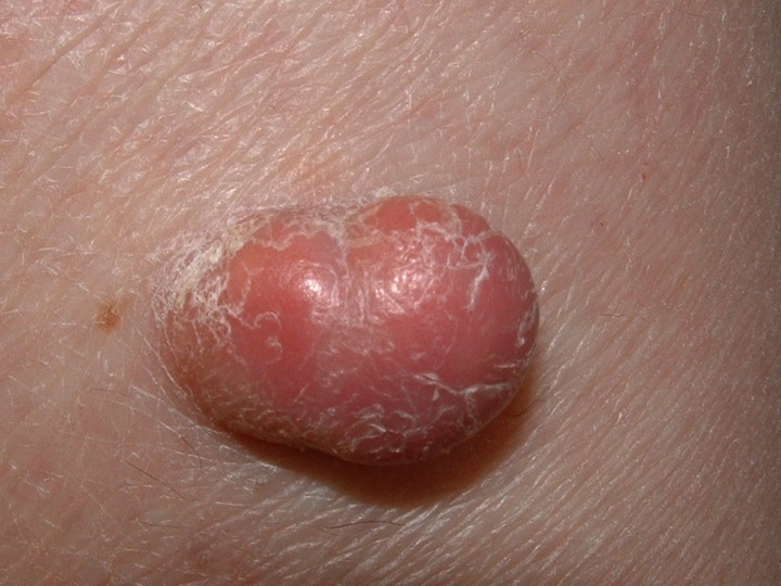 Basal Cell Carcinoma In Dogs Pictures Basal Cell Carcinoma In Dogs Pictures