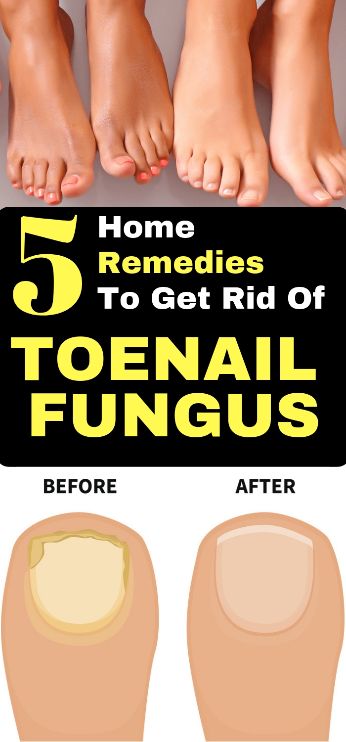 Daily Health Advisor 5 Home Remedies for Toenail Fungus
