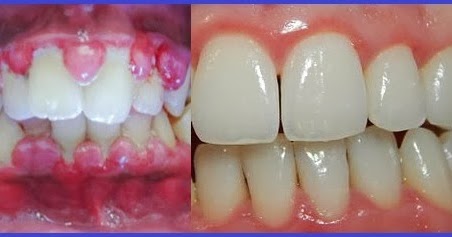 Natural Gum Disease Treatment And Prevention Natural Gum Disease Treatment And Prevention