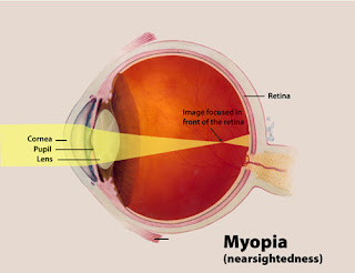 Myopia vision