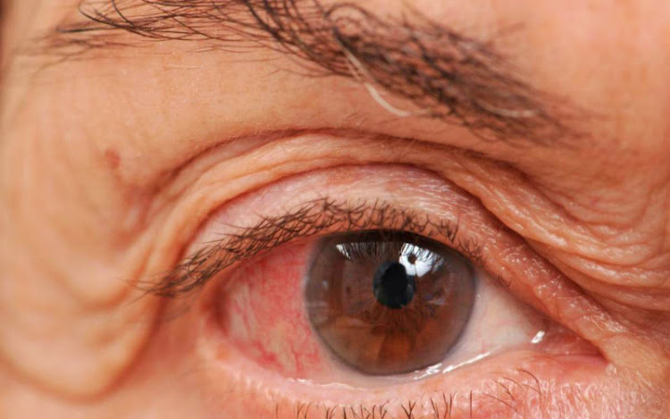 ¿Puede la hipertensión causar síntomas de glaucoma de ángulo abierto?