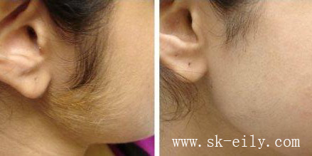 laser-hair-removal-0521-1.jpg