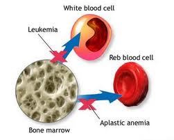 Image result for Anemia aplasia (Aplastic anemia)