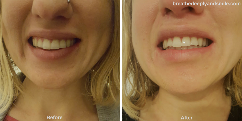 Breathe Deeply and Smile AtHome Teeth Whitening for a Coffee Drinker