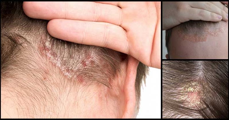 Natural Remedies For Scalp Psoriasis Dr. Farrah MD