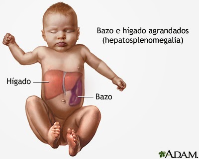 Causas de hepatomegalia en recien nacidos
