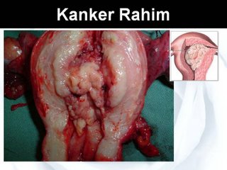 Resep Obat Kanker Rahim Paling Ampuh Tradisional, tips alami tradisional mengobati kanker rahim, pengobatan kanker rahim
