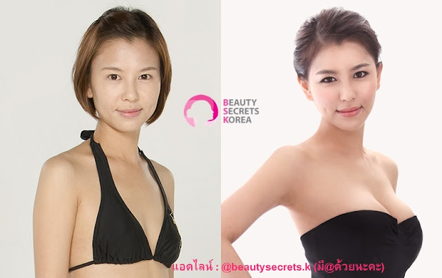 ทำหน้าอกที่ไหนดี ทำหน้าอกที่ไหนดี