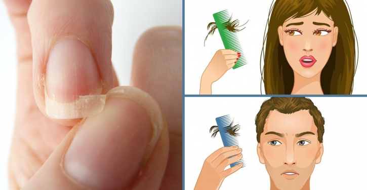 Foods To Eat If You Have Brittle Nails, Hair Loss Or Insomnia