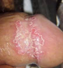 blister in penis shaft - Dermatology - MedHelp