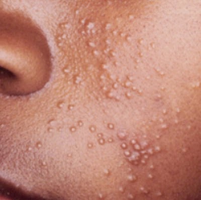 Fever, Skin blisters and Skin bumps: Common Related ...