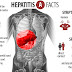 Hepatitis A Musuh Besar Organ Hatimu
