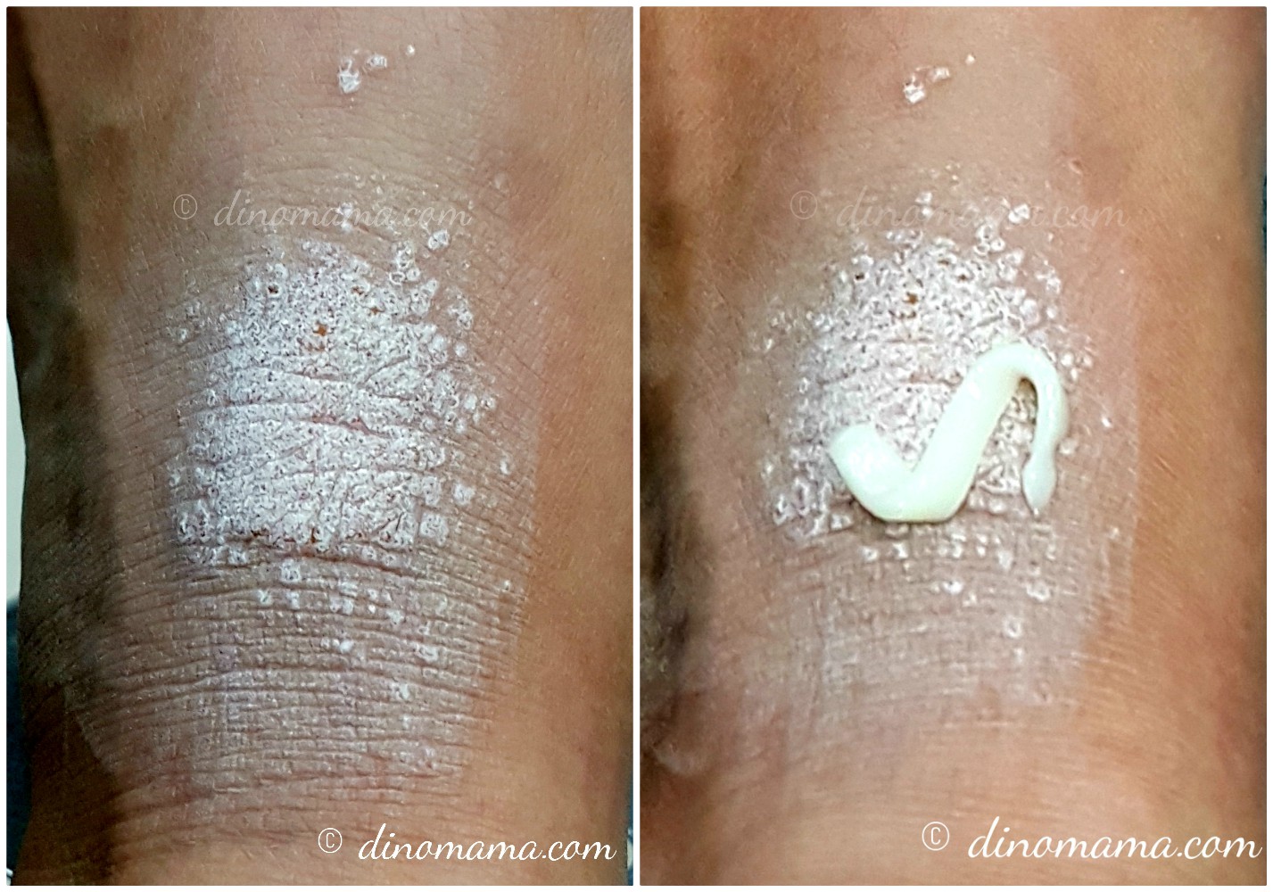 Keep Eczema under control with Theo10® Moisturiser and Eczema cream