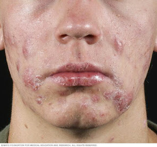 https://www.simplyeasylife.com/2018/10/acne-no-more-does-it-cure-acne-permanently-and-naturally.html