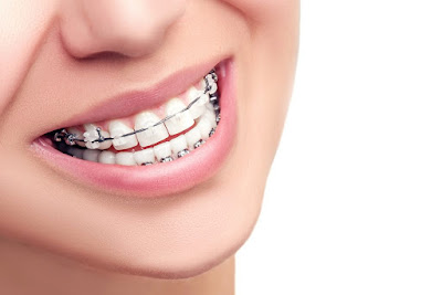 Niềng răng người lớn mang lại lợi ích gì?