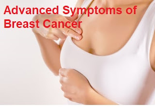 Advanced Symptoms of Breast Cancer Advanced Symptoms of Breast Cancer