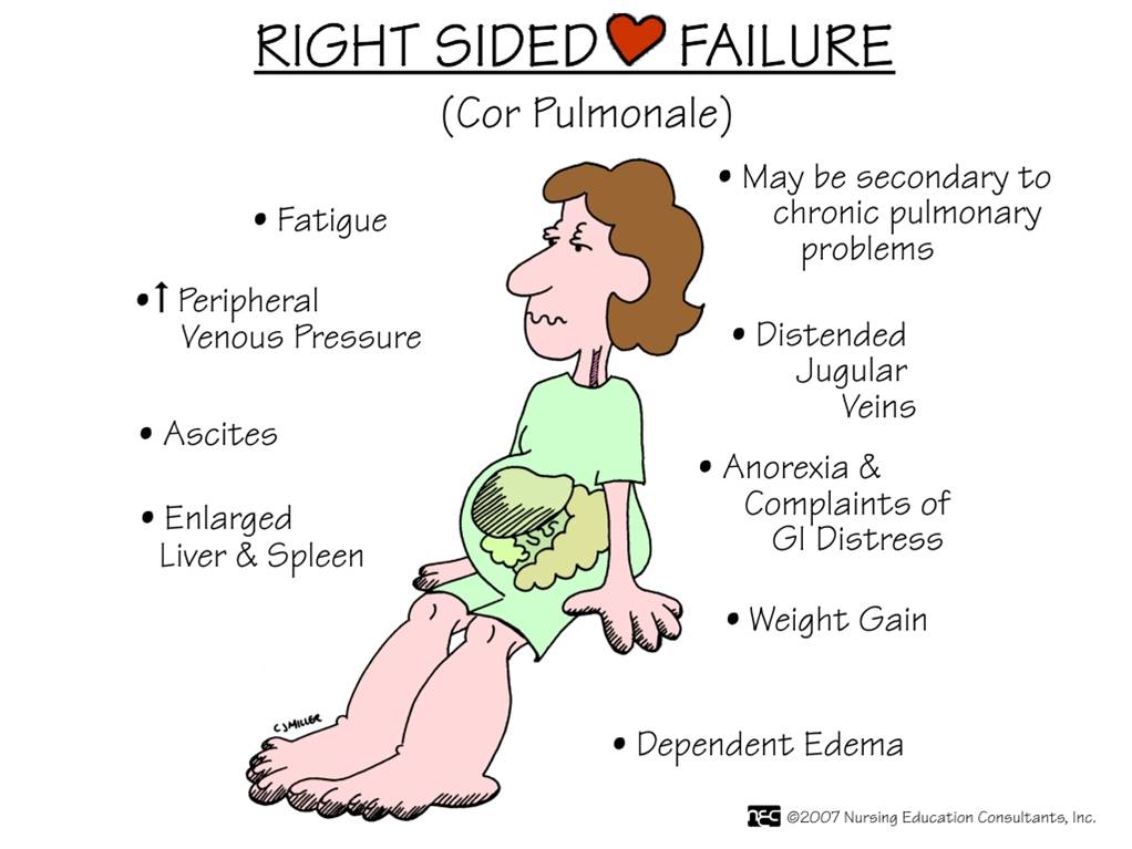 Symptoms of right sided heart failure vs left