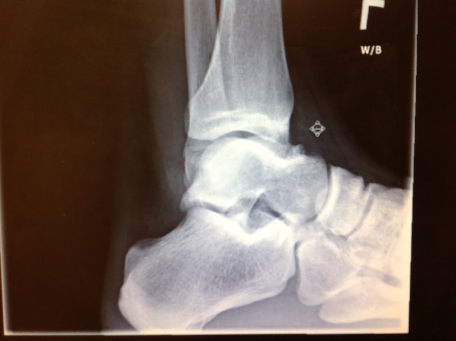 Foot and Ankle Problems By Dr. Richard Blake Anterior (Front) Ankle