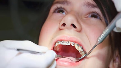 Niềng răng có nên nhổ răng khôn?