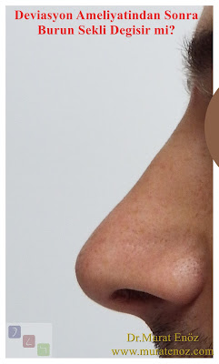 Does the shape of the nose improve after the operation of the Septoplasty? - Does the Septoplasty operation change the shape of the nose? - Does the shape of the nose change after the operation of the Septoplasty? - Nasal shape after Septoplasty - Does the nose shape change after Septoplasty? - Does the nose shape affected by the operation of the Septoplasty?