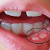 ऐसे भी किया जा सकता है मुँह के छालों का इलाज - Home Remedy for Mouth Sores in Hindi