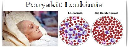 Image result for penyakit leukimia