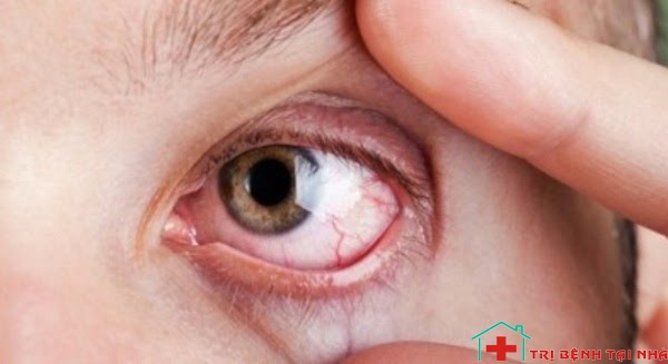5 loại bệnh thường gặp về mắt