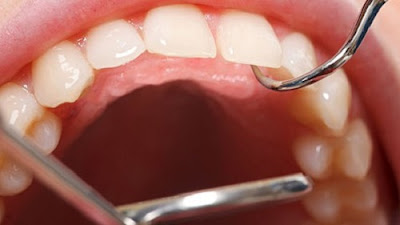 cạo vôi răng bị chảy máu nhiều có sao không -3