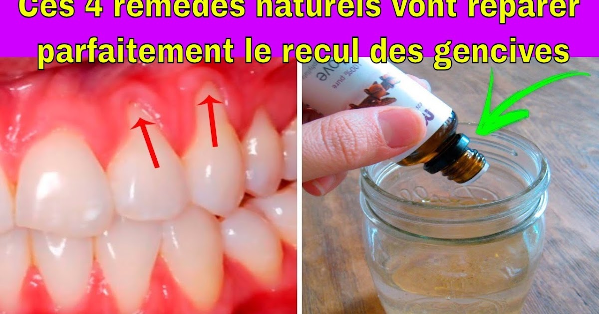 Remèdes naturels vont réparer le recul des gencives Sport et Santé